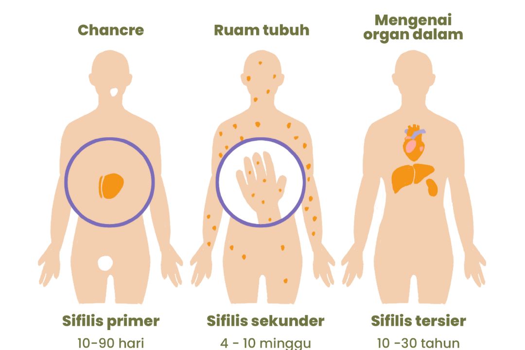 Sifilis Gejala Penyebab Komplikasi Cara Mengobati