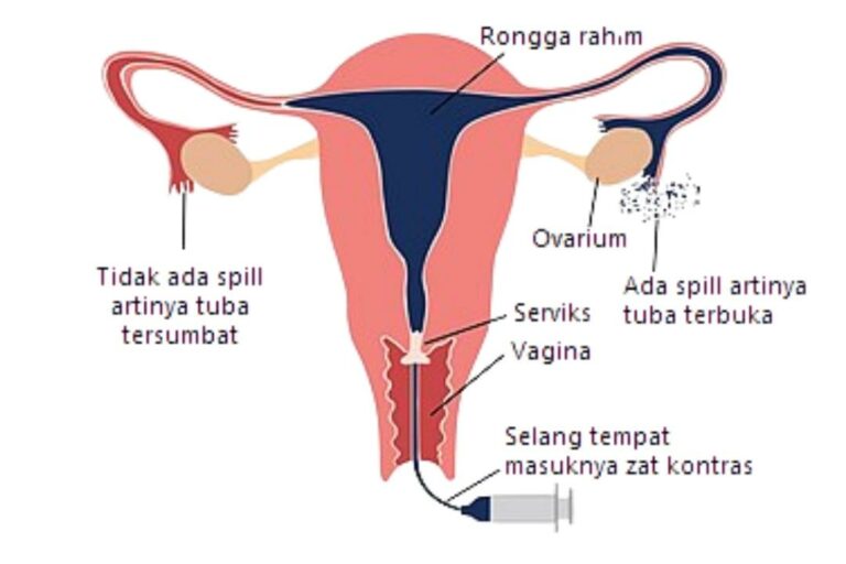 prosedur HSG