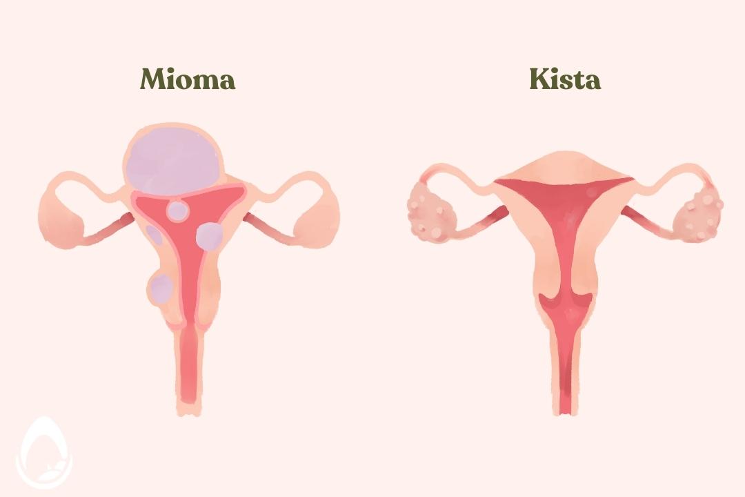 Perbedaan Miom Dan Kista Mana Yang Lebih Berbahaya