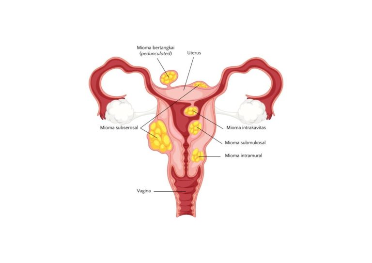 Apa Yang Dimaksud Miom Mioma Itu Mempengaruhi Kesuburan
