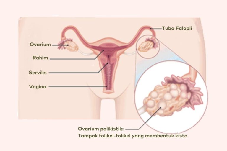 Gambar PCOS