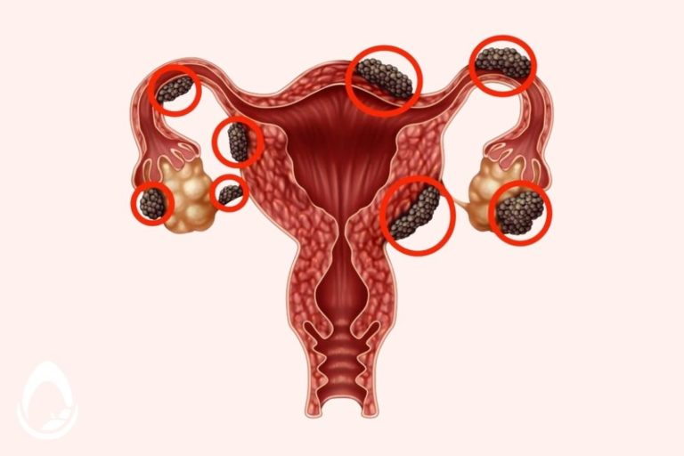 Endometriosis Gejala Penyebab Dan Pengobatannya 