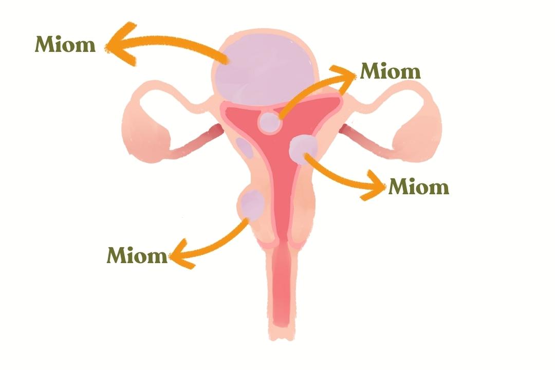 Operasi Miom Apakah Berbahaya? Bocah Indonesia