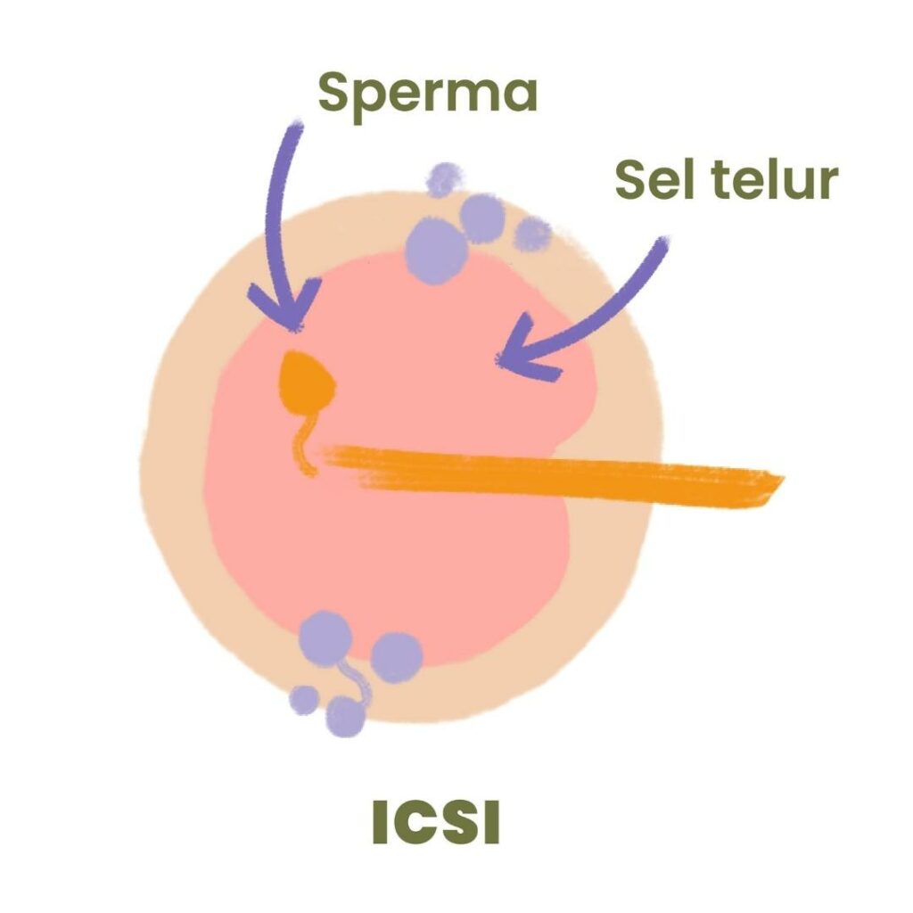 Icsi Dan Imsi Dalam Program Bayi Tabung Bocah Indonesia