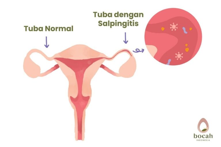 gambar tuba dengan salpingitis