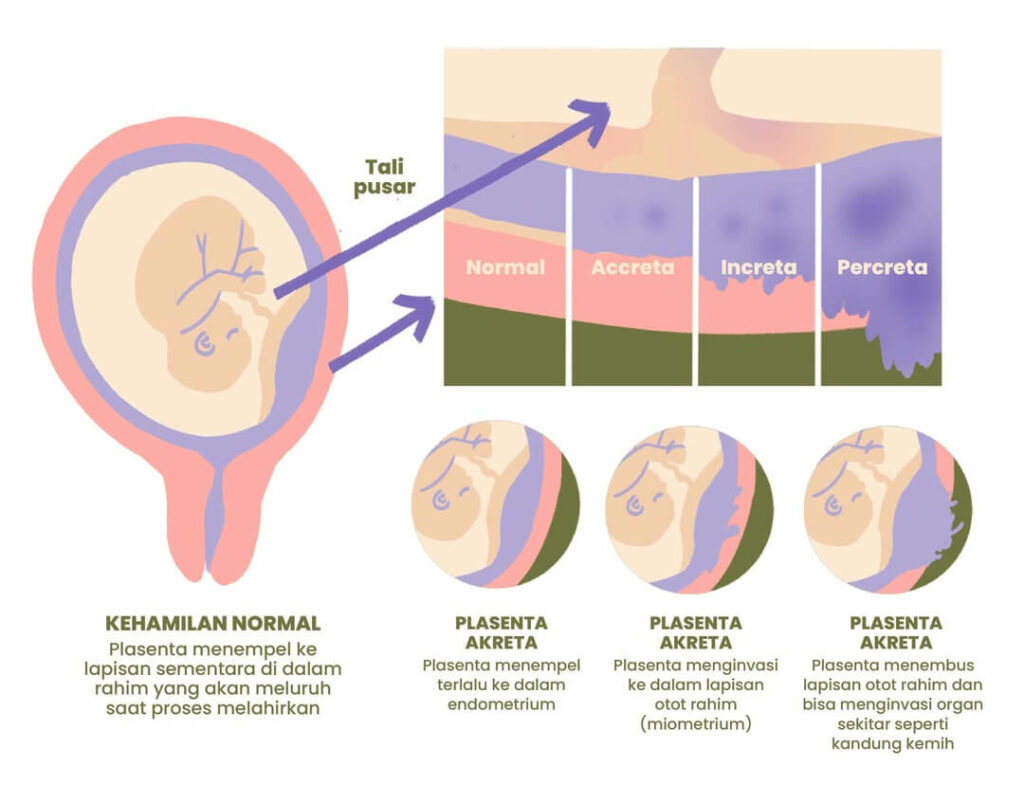 klasifikasi-plasenta-previa