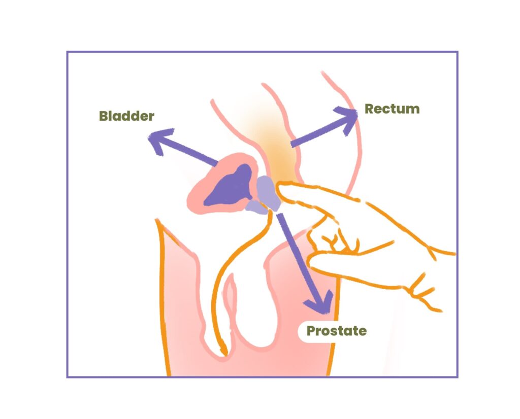 tipe-tipe-prostatitis