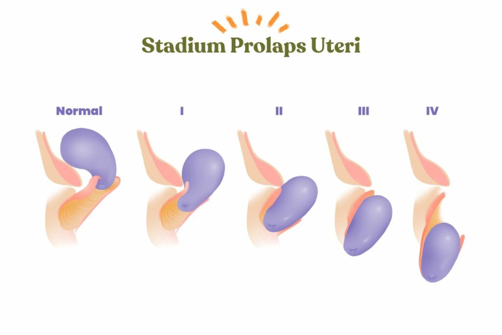 stadium prolaps uteri custom