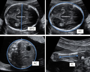 Pemeriksaan ultrasonografi (USG). Parameter biometri janin