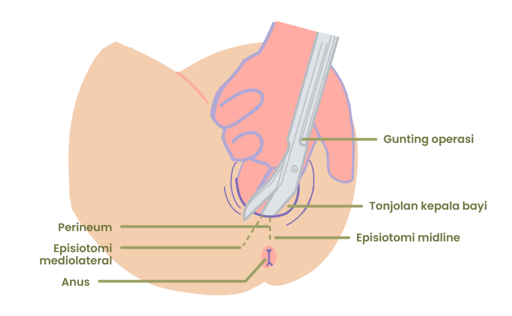 episiotomi