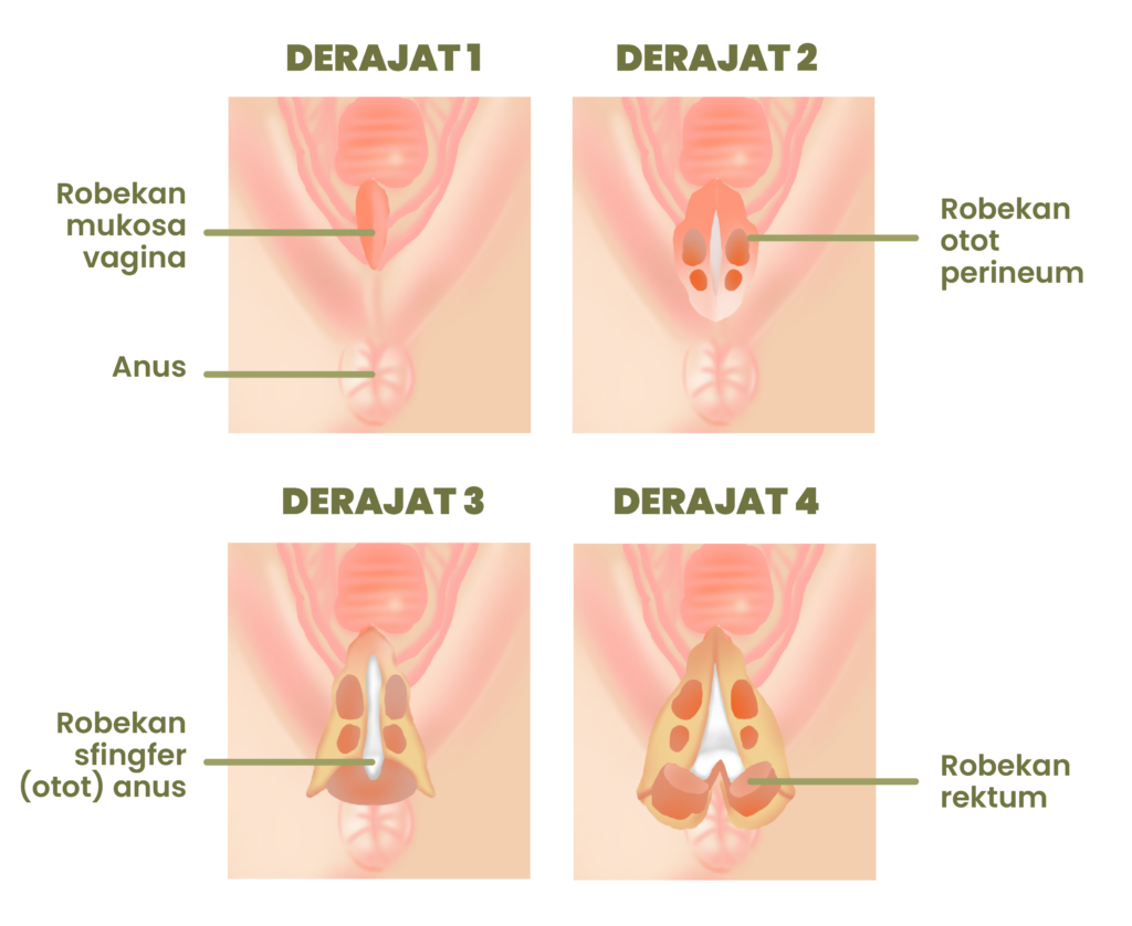 episiotomi2