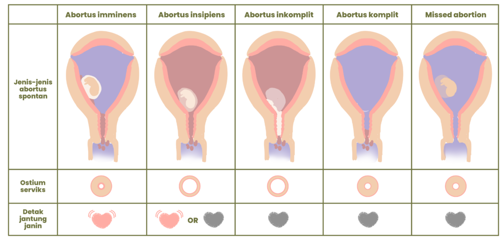 abortus inkomplit