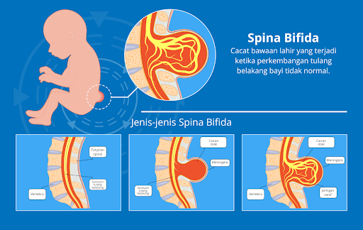 Spina Bifida: Penyebab, Gejala, Dan Perawatan