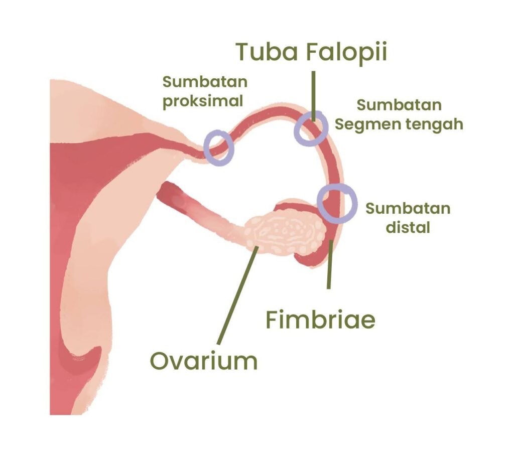 tuba falopii tersbumbat