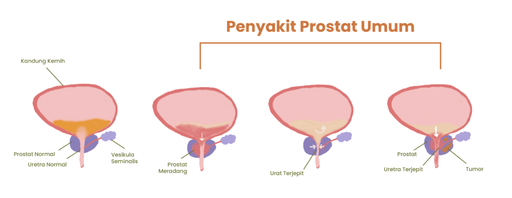 Penyakit Prostat yang umum
